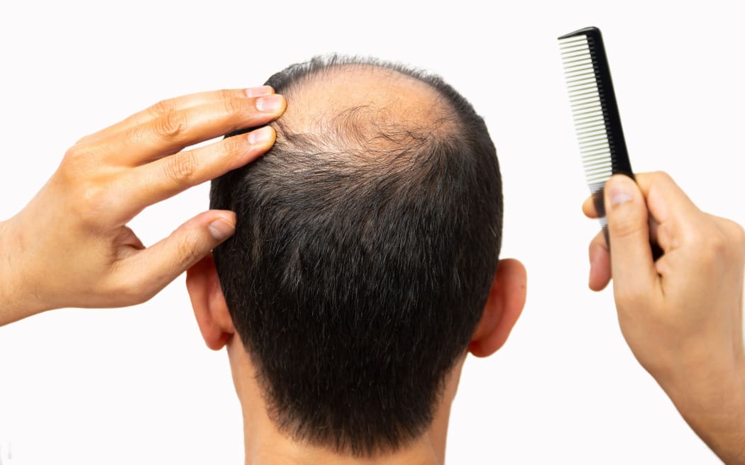 Tall claims for hair loss treatments led to big fines for business | RNZ  News