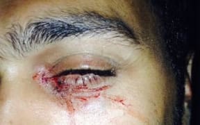 The Refugee Action Coalition says an Iranian refugee, "Mehrzad", was attacked and hit in the face with a rock on Nauru.