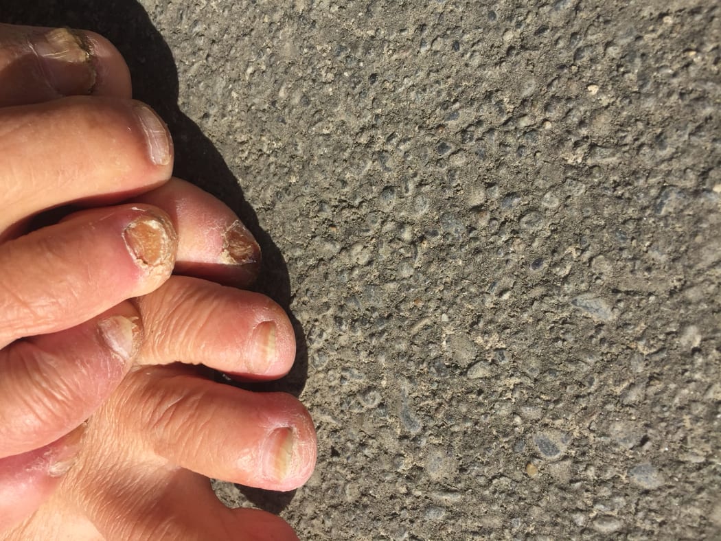 A close up of Bruce's toes with blisters and damaged toenails.