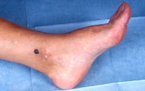 Melanoma on an ankle