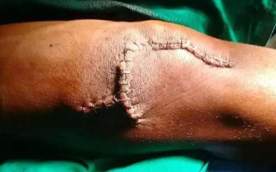 The injured arm of a Manus refugee.