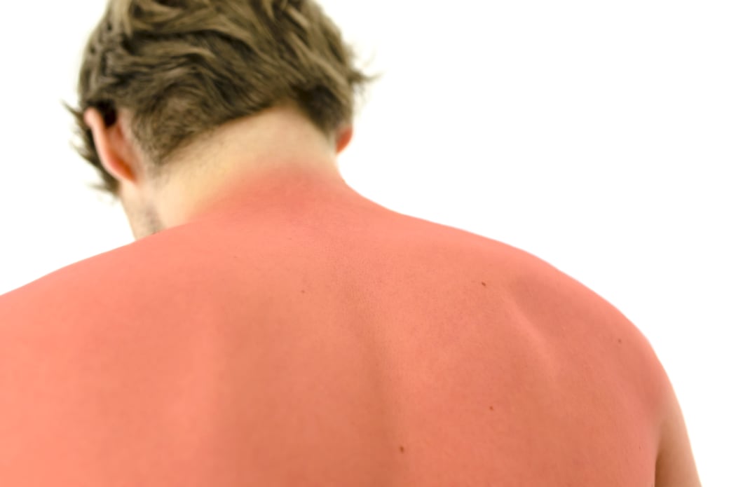 Can You Get Rid Of Sunburn Fast What To Do To Help Ease Red Itchy Skin Rnz News 