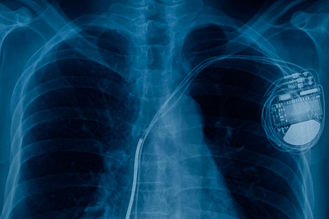 Pacemaker x-ray image.