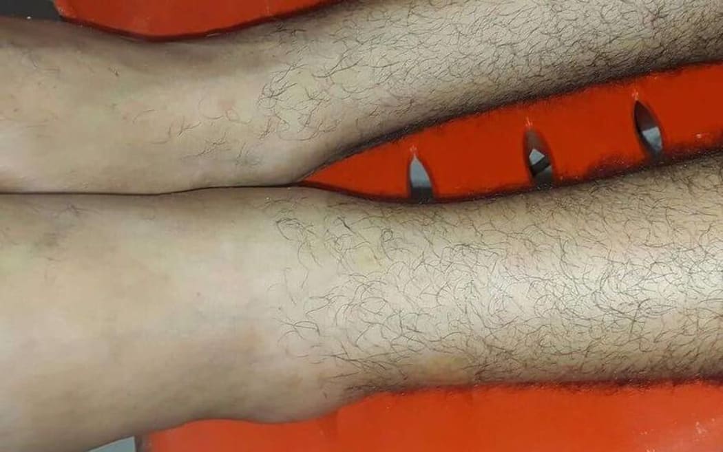 The swollen left ankle of Azzam el Sheikh.