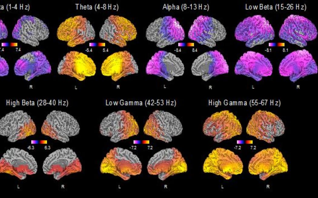 Brain activity changes in patients with treatment-resistant depression receiving ketamine as therapy