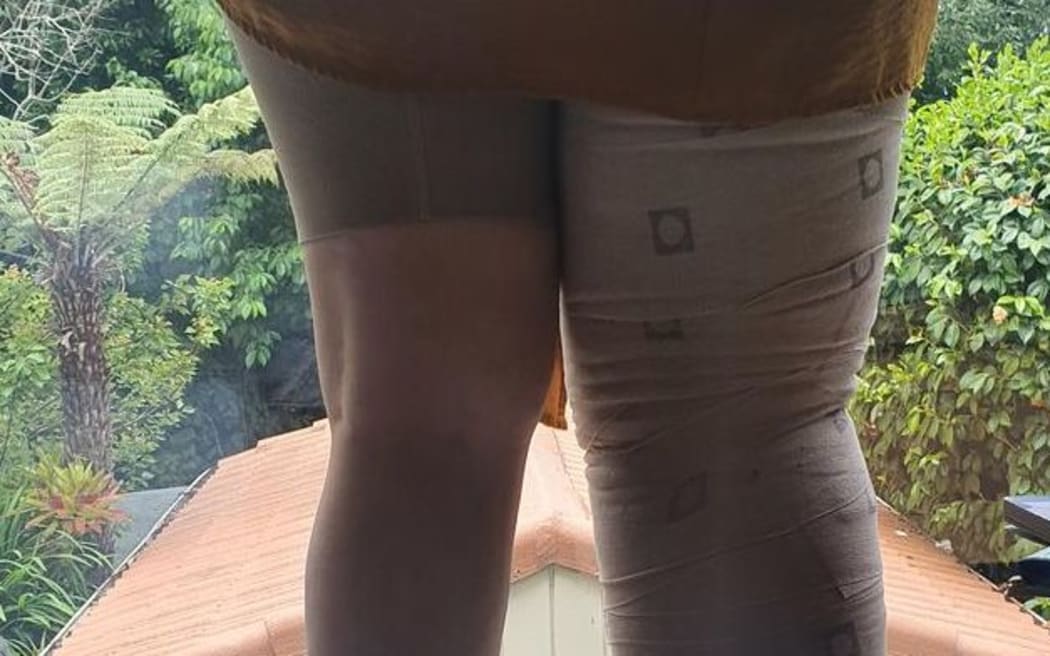 Melanoma survivor Joyanne Lovatt who developed lymphoedema - her legs before surgery