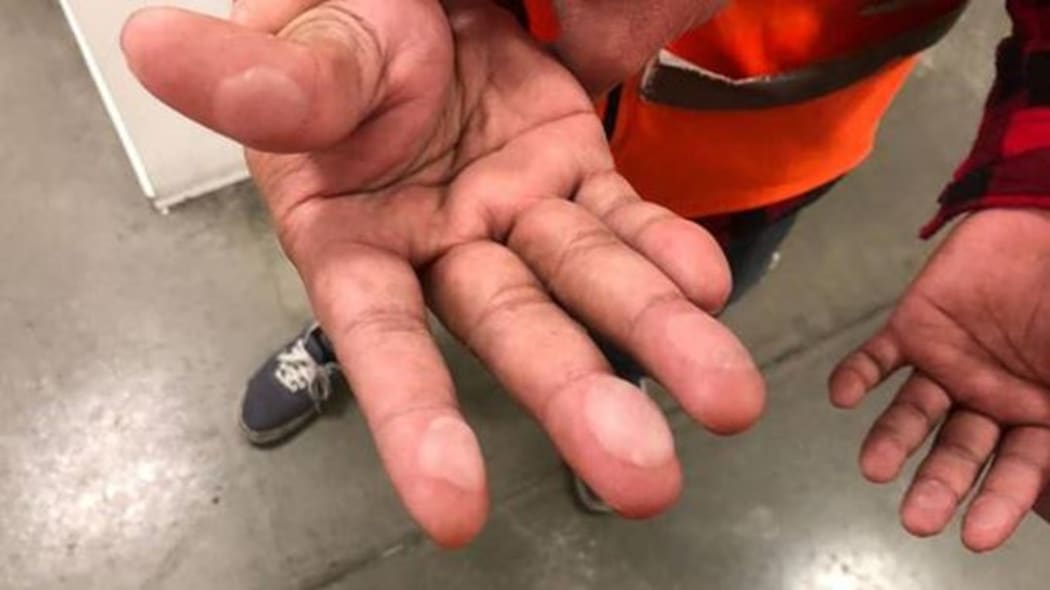 This image of a Sistema worker with blistered hands has been handed out at many distributing stores.