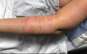 Burns on a nurse's body after she was attacked by a patient at Hillmorton Hospital in Christchurch.