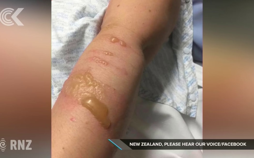 Nurse left with severe burns after patient attacked