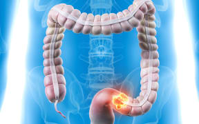 An illustration showing cancer in the bowel.