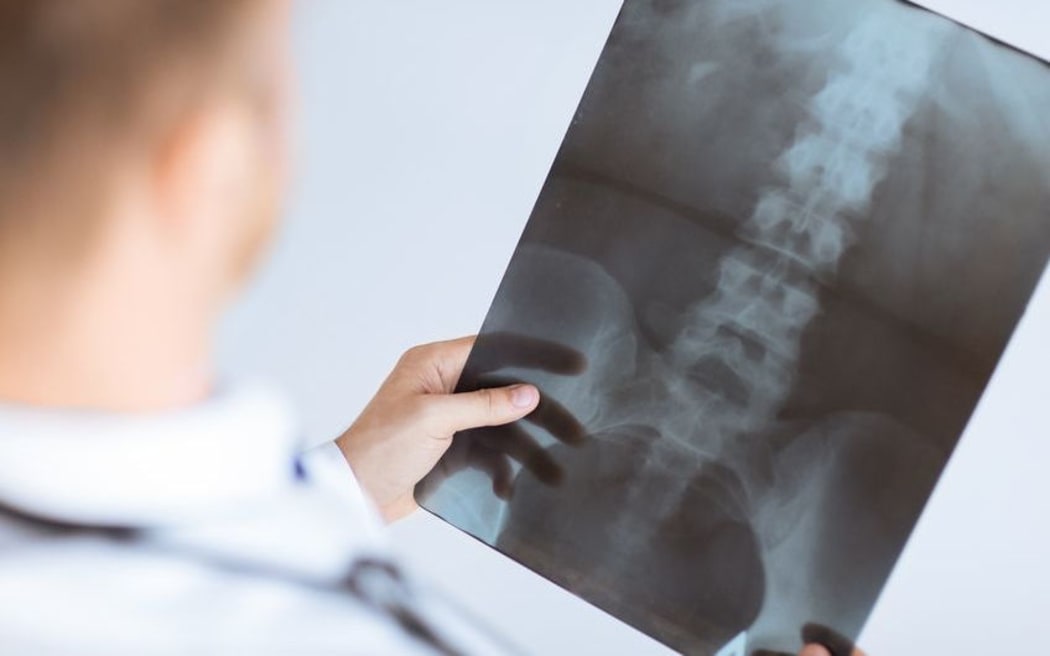 doctor holds picture of spinal xray