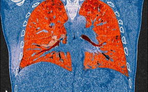 A CT scan of lungs showing the effects of Covid-19.