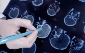close-up of the doctor hand pointing to the brain CT