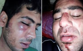 Photos of injuries suffered by two refugees in an attack on New Years Eve, 2016.
