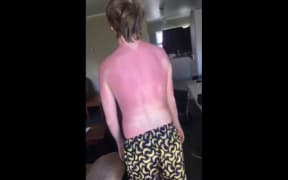 Te Kuiti resident Margaret says her son has spent a week and a half in agony after being sunburnt despite using sunscreen.