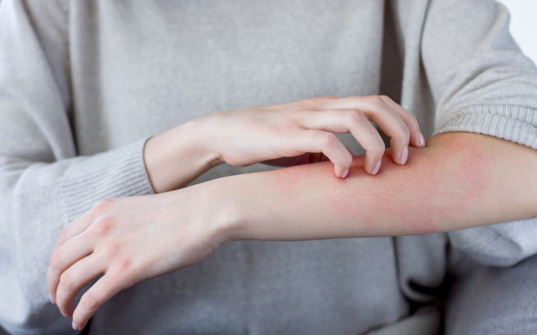 Latching, hatching and scratching All you need to know about scabies