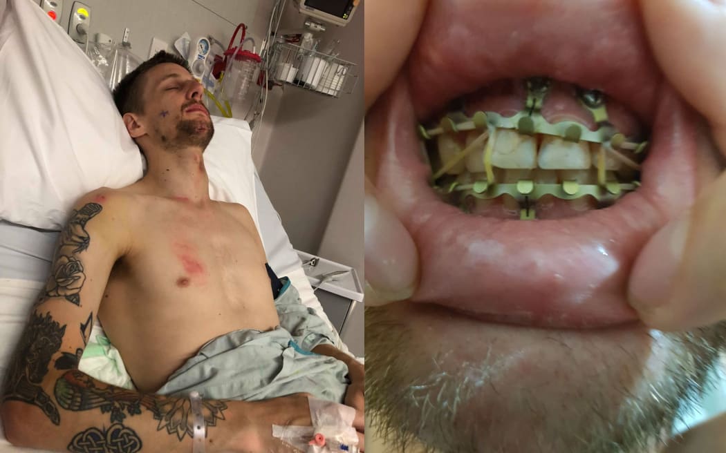 Liam Thompson's jaw was broken when he was flung over the handlebars of a scooter when it braked.