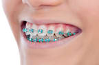 Metal braces for teeth